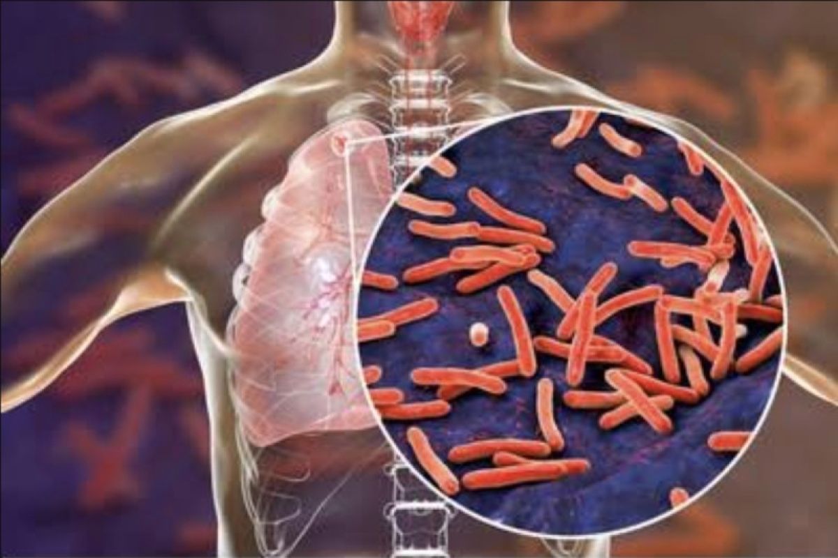 Gejala dan Cara Mengatasi Penyakit Tuberkulosis 2023
